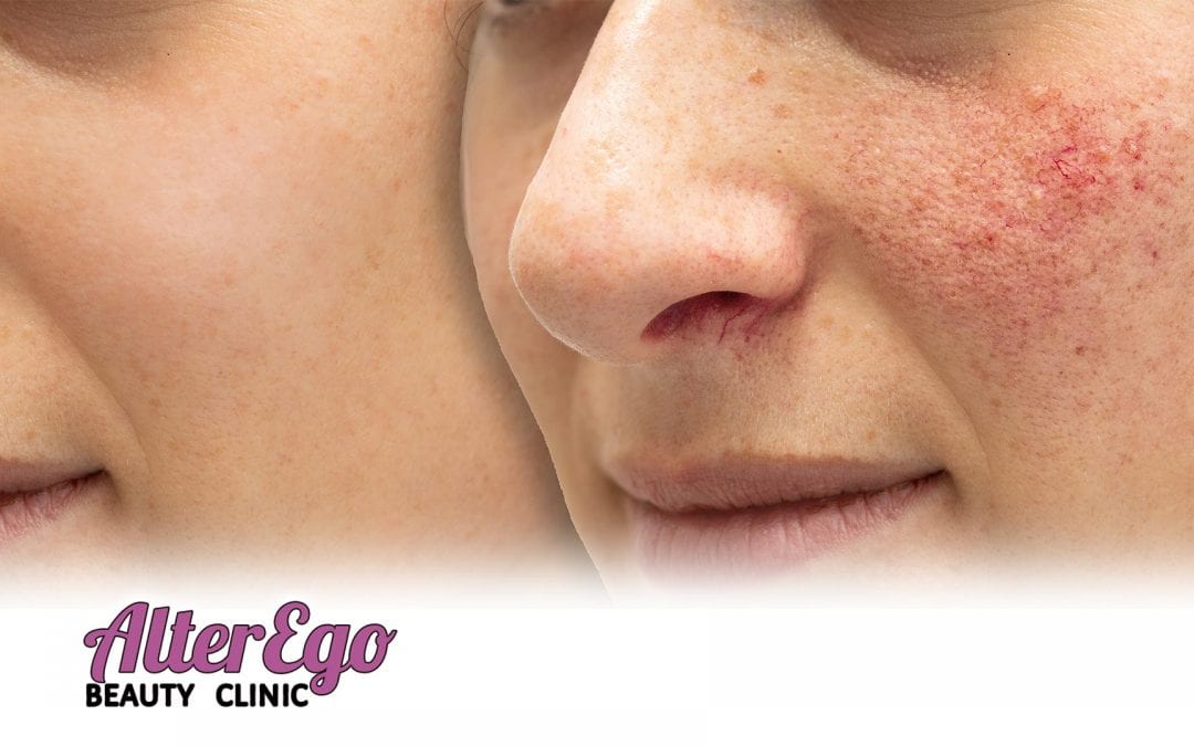 Diagnosis: Rosacea-What is it? Can it be cured?
